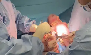 Em bé chào đời trong bọc u xơ tử cung 8 kg Em bé chào đời trong bọc u xơ tử cung 8 kg