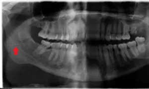 Bác sĩ làm kẹt kim tiêm trong miệng bệnh nhân khi nhổ răng Bác sĩ làm kẹt kim tiêm trong miệng bệnh nhân khi nhổ răng