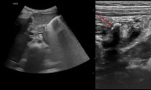 Bé trai bị viêm ruột thừa mủ Bé trai bị viêm ruột thừa mủ