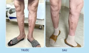 Huyết khối chân sau 20 năm không chữa suy giãn tĩnh mạch Huyết khối chân sau 20 năm không chữa suy giãn tĩnh mạch