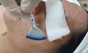 Peel da có làm mỏng da không? Peel da có làm mỏng da không?