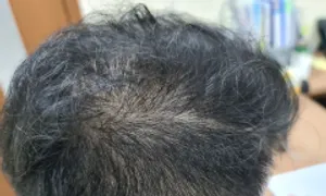 Tại sao lăn kim trị rụng tóc tại nhà không hiệu quả? Tại sao lăn kim trị rụng tóc tại nhà không hiệu quả?