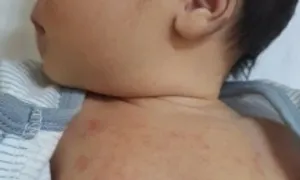 Vì sao trẻ sơ sinh có mụn sữa?
